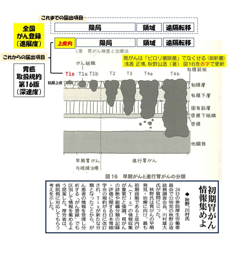 Image for the Tweet beginning: 国会質疑を通じて、全国がん登録における胃がんについての届出項目が、今後変更されます。
これまで、胃がんの進展度については、Tisを含むT1a～T3をまとめて『限局』として報告を求めてきたところ、今後は、
・Tisを『上皮内がん』として、T1a～T3を『限局』として、 
